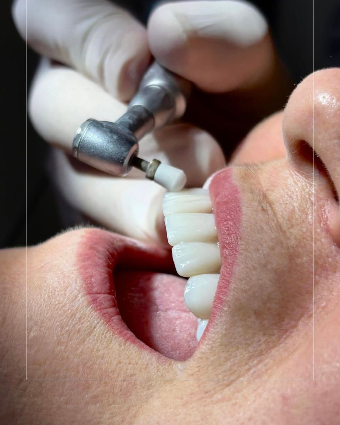 Registro clínico de procedimento odontológico realizado pelo Dr. Alan