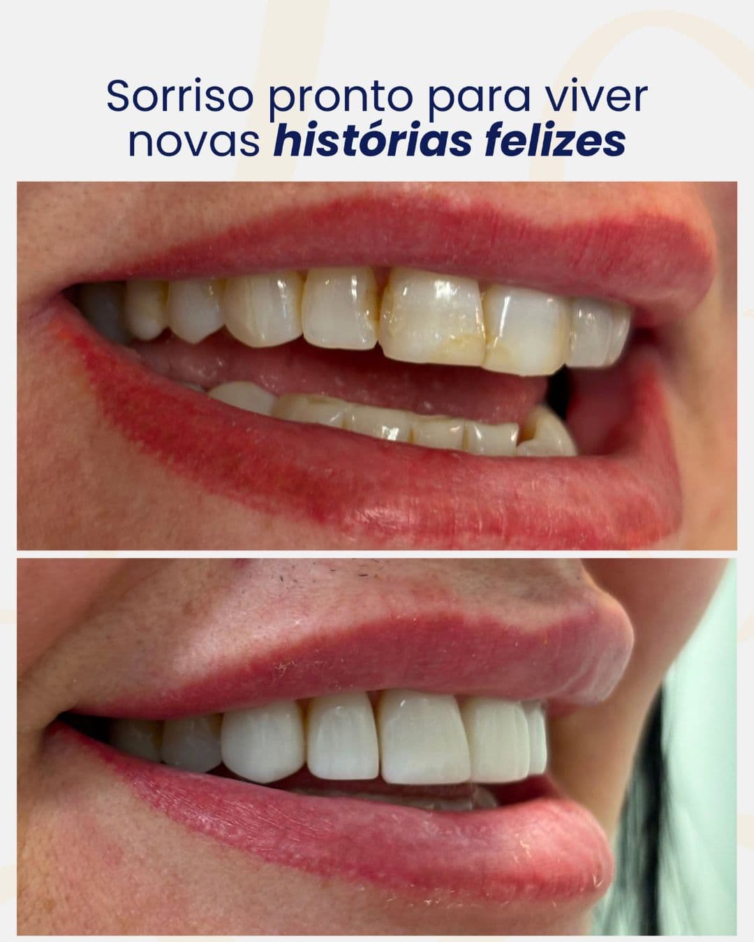 Resultado Antes e Depois - Caso 02 - Dr. Alan Buchmann